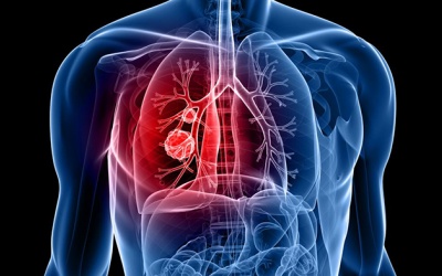 Ung thư phổi không tế bào nhỏ phẫu thuật được không?