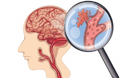 Cách phòng ngừa tái phát đột quỵ não
