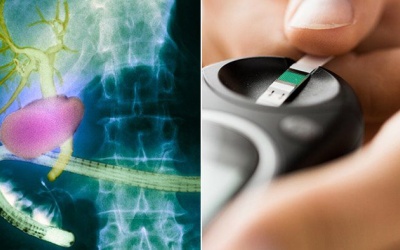 Sỏi bùn túi mật 6,5mm, đái tháo đường dùng TPBVSK Kim Đởm Khang được không?