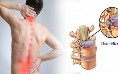 Tiến triển bệnh thoát vị đĩa đệm và giải pháp cải thiện hiệu quả