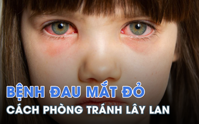 Làm gì để phòng tránh lây lan đau mắt đỏ?