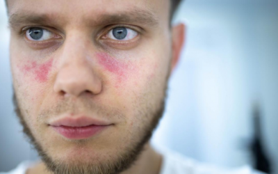 Chế độ dinh dưỡng cho người bị lupus ban đỏ