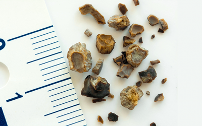 Có sỏi mật 12mm nên điều trị thế nào mới tốt?