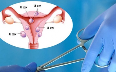 Khi nào cần mổ u xơ tử cung?