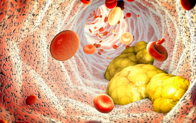 6 dấu hiệu cảnh báo máu nhiễm mỡ và cách cải thiện