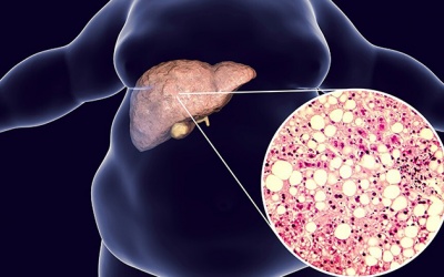 Chế độ ăn giúp phòng, chống bệnh gan nhiễm mỡ không do rượu