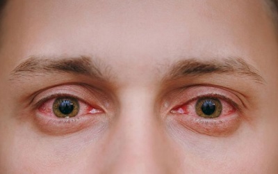 Dịch đau mắt đỏ lây lan cả nước, Bộ Y tế khuyến cáo 5 biện pháp phòng bệnh