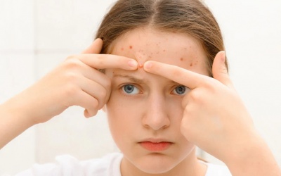 Nguyên nhân nào khiến trán nổi mụn?