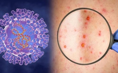 TP.HCM thông tin về 2 trường hợp mắc bệnh đậu mùa khỉ 