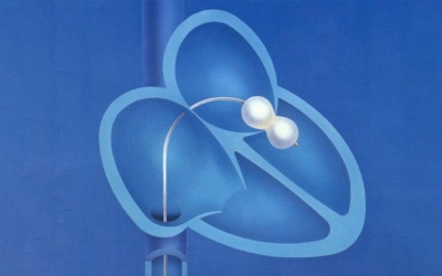 Hẹp van tim 2 lá nhưng không nong van tim có được không?