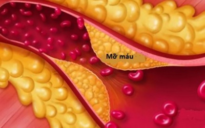 4 hệ lụy nguy hiểm của mỡ máu cao 