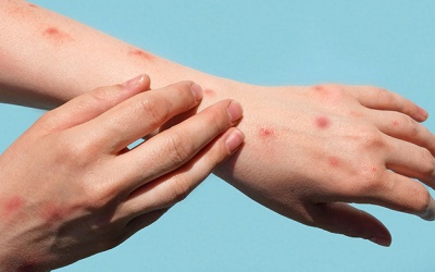 Thêm ca đậu mùa khỉ thứ 6, nên làm gì để phòng bệnh?