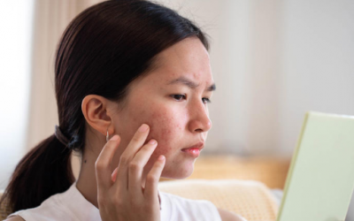 Nguyên nhân gây mụn nang và cách điều trị