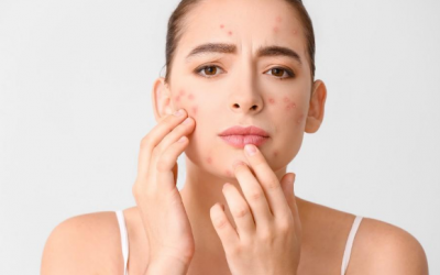 3 điều cần tránh khi da nổi mụn