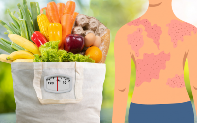 Người bị vảy nến nên ăn gì để phục hồi làn da?