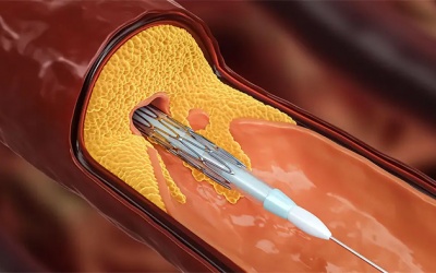 Người bệnh thiếu máu cơ tim có thể gặp biến chứng gì sau đặt stent?