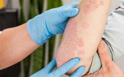 Tìm hiểu về vảy nến thể mủ