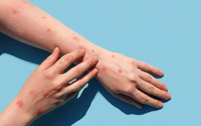 Chỉ trong 1 tuần TP.HCM ghi nhận thêm 6 ca đậu mùa khỉ