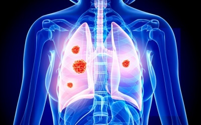 Loại ung thư khiến người mắc có thể tử vong chỉ sau 2 tháng