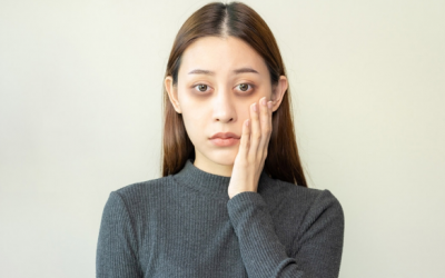 Mắt thâm quầng có thể do thiếu một số vitamin và khoáng chất