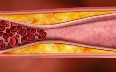 Bị bệnh mạch vành nhưng không đặt stent được phải làm sao?