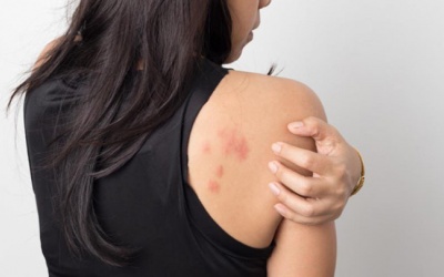 Bị đau sau zona thần kinh phải làm gì?