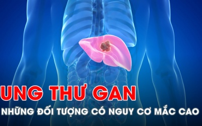 Ai có nguy cơ cao mắc ung thư gan?