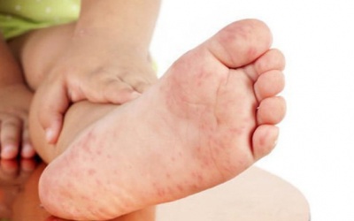 Trẻ bị tay chân miệng độ 1 mấy ngày thì khỏi?