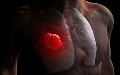 Các triệu chứng của ung thư phổi giai đoạn 3