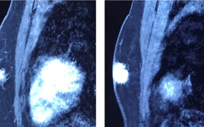 Cẩn trọng với ung thư tuyến vú ở nam giới