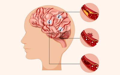 Sai lầm nên tránh khi xử trí đột quỵ não