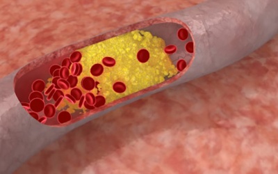 Tác dụng phụ của thuốc hạ mỡ máu  