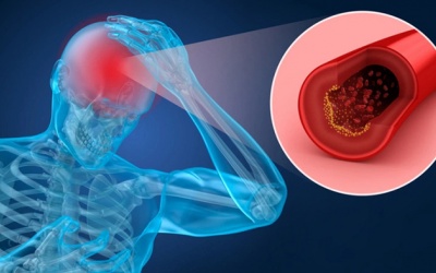 Nỗi đe dọa mang tên cục máu đông trong não