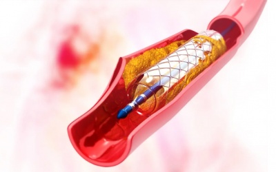 Bị bệnh mạch vành, đặt nhiều stent rồi không đỡ phải làm sao?
