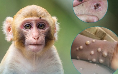 Bộ Y tế 'nhắc' giám sát và phát hiện sớm ca bệnh đậu mùa khỉ
