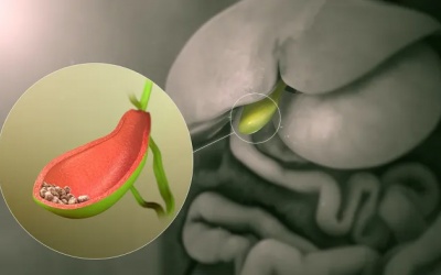 Sỏi mật 17mm dùng TPBVSK Kim Đởm Khang có tác dụng không?