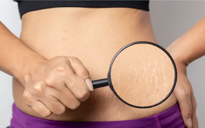 Rạn da có phải vấn đề nguy hiểm?