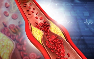 Biện pháp giúp kiểm soát mỡ máu hiệu quả