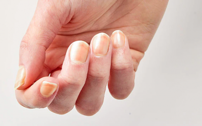 Nguyên nhân móng ngả màu vàng?