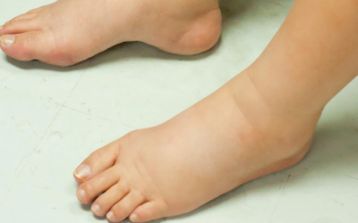 Làm thế nào ngăn suy thận độ 2 tiến triển sang độ 3?