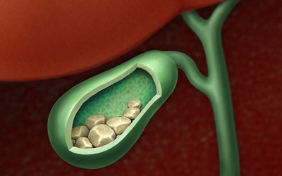 Sỏi túi mật 3cm có nguy hiểm không, nên xử trí thế nào?