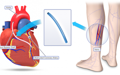 Phương pháp bắc cầu động mạch vành có hiệu quả tối đa bao nhiêu năm?
