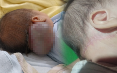 Phẫu thuật cắt bỏ khối u máu hiếm gặp ở bệnh nhi sơ sinh