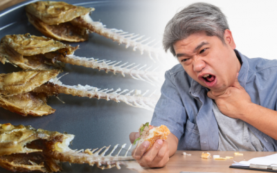 Cảnh báo nguy cơ thủng đường tiêu hóa do hóc xương cá