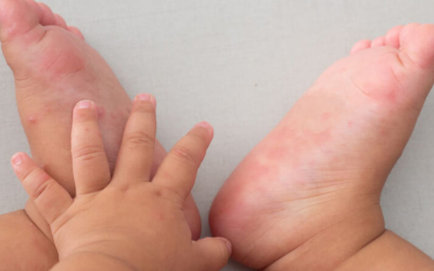 Tránh 4 sai lầm này khi điều trị tay chân miệng