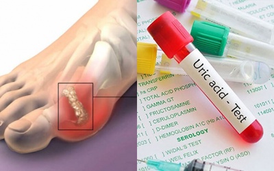 Acid uric tăng cao: Nguy cơ gặp phải bệnh gout