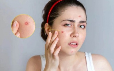 Biện pháp xử lý mụn trứng cá tại nhà