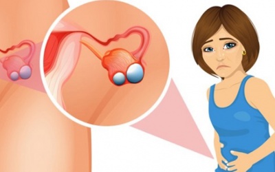 Dấu hiệu u nang buồng trứng và cách cải thiện hiệu quả từ thảo dược