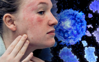 Lupus ban đỏ tái phát phải làm sao?