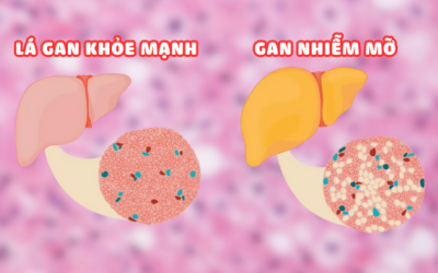 Gan nhiễm mỡ: Nguyên nhân, triệu chứng và giải pháp từ thảo dược